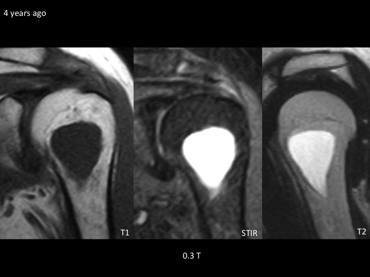 Figure 3 for case simple bone cyst ( RID3945 )